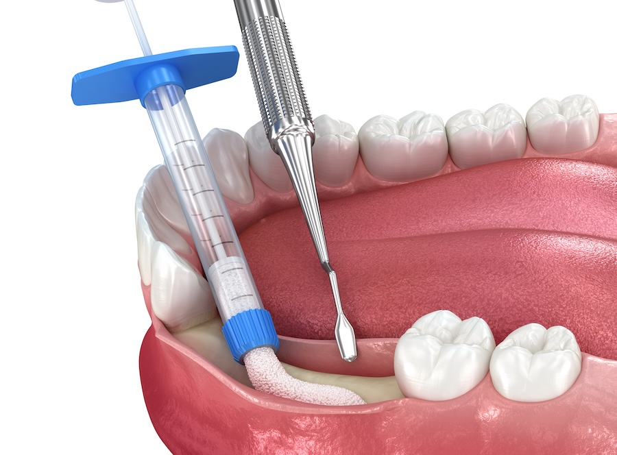 Reasons You May Need a Bone Graft