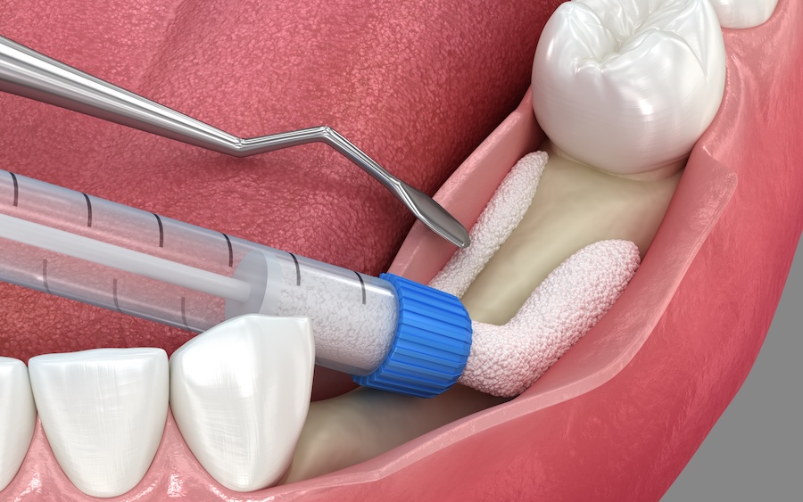 What Is a Jawbone Graft?