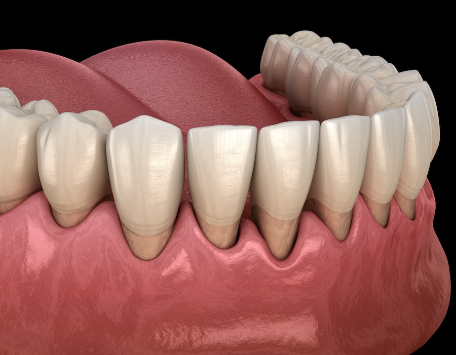 What Causes Gum Recession