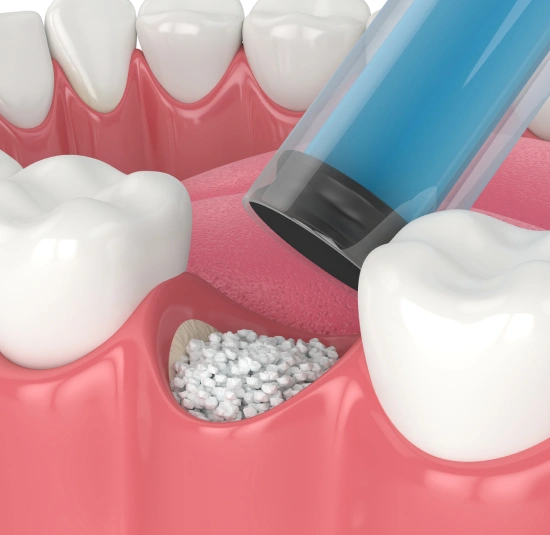 Bone Grafting