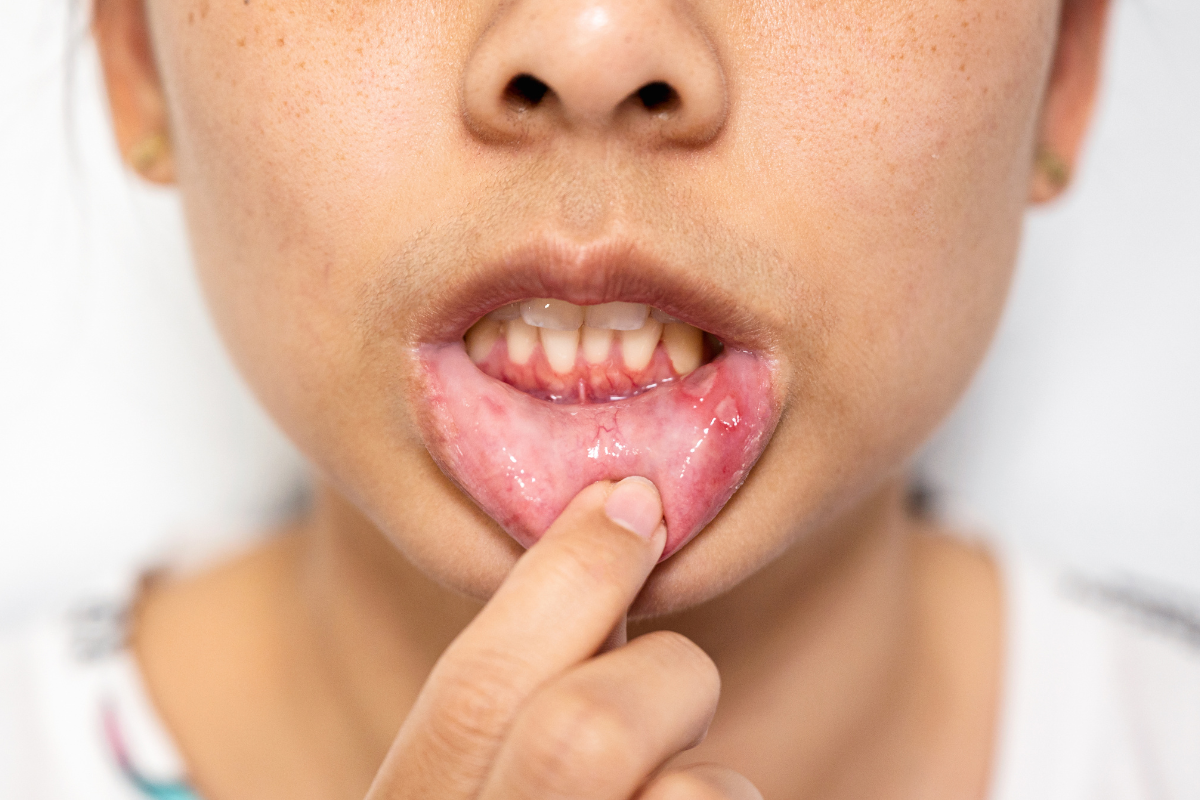 Child with inflamed gums showing redness and swelling, illustrating gum disease symptoms requiring dental treatment.